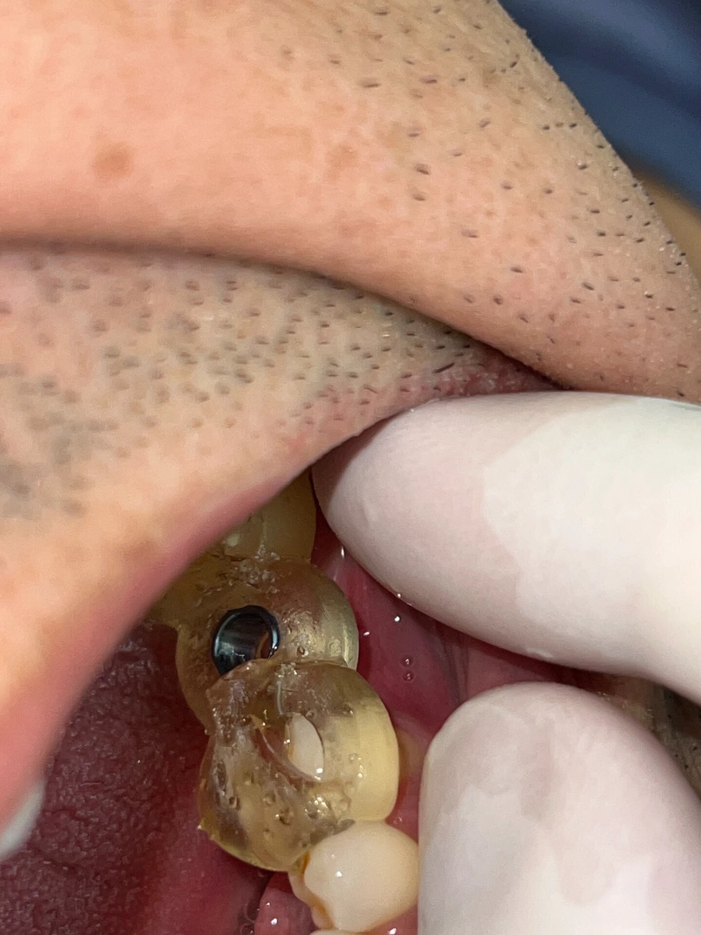Guia cirúrgico posicionado em boca durante a cirurgia de implante