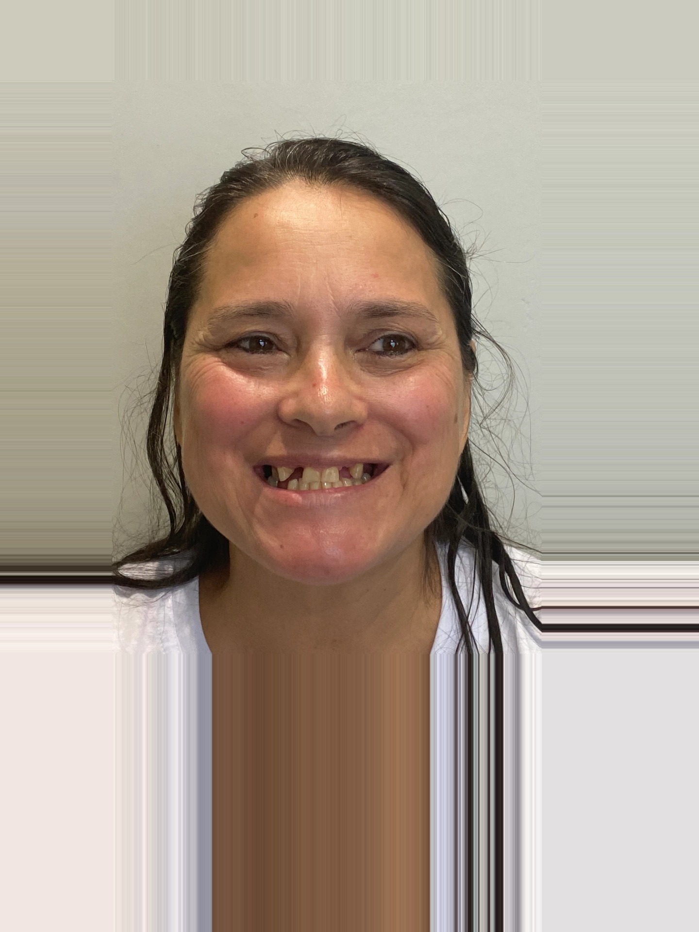 Reabilitação estética do sorriso — antes